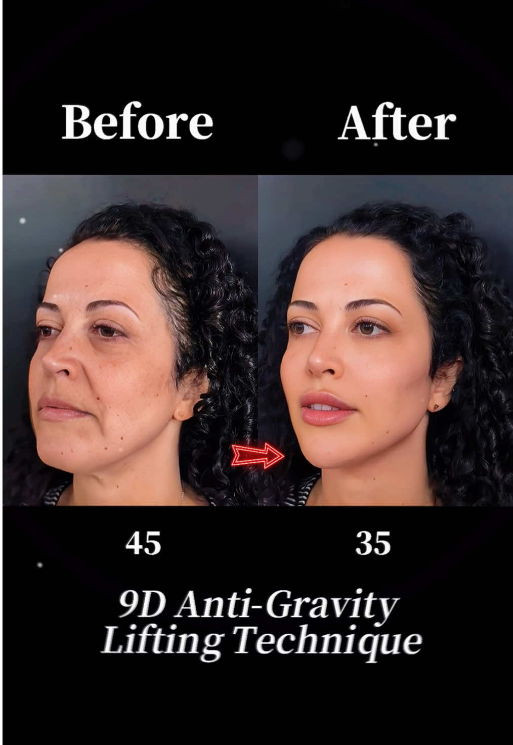 #facelift #antiaging #facelifting #plasticsurgery ‎#تركيز الوجه#拉皮手术 