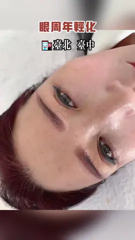 #提眉 #無痕提眉 #眼周筋膜提升 #眼周三件套 