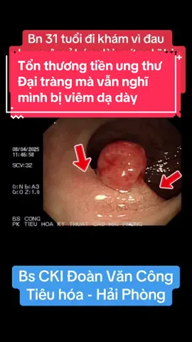 31 tuổi đau bụng kéo dài, nghĩ mình viêm dạ dày, điều trị mãi không khỏi. Bs Công soi phát hiện tổn thương tiền ung thư đại tràng. PHÒNG KHÁM TIÊU HOÁ KỸ THUẬT CAO HẢI PHÒNG. 77a Trực Cát, Vĩnh Niệm, Lê Chân, Hải Phòng. 0932384226 #haiphong #haiphongphoto #haiphongcity #haiphong24h #daday #đaitrang #noisoitieuhoa #ungthu #bscong #tieuhoa #thuocnamsuckhoe #men #nhi #thuocnam #xuhuong #xuhuongtiktok 