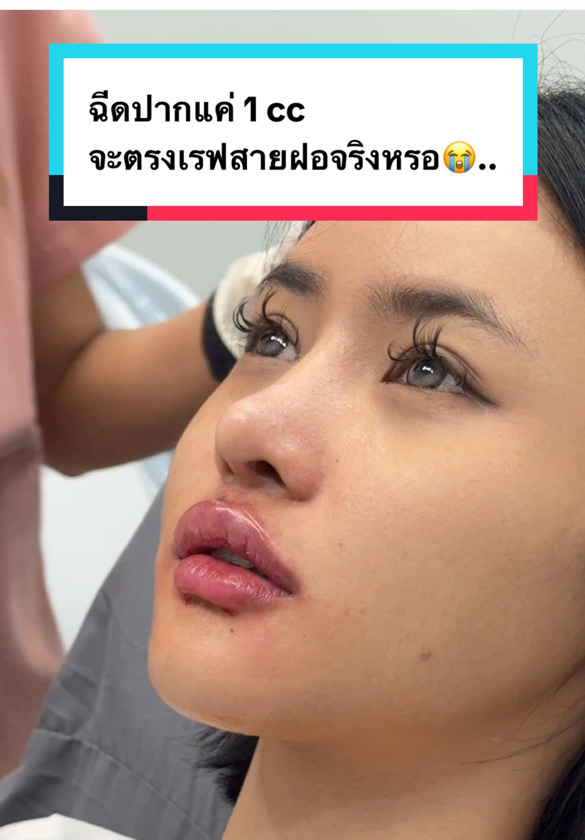 ฉีดปากแค่ 1 cc จะตรงเรฟสายฝอจริงหรอ😭.. #AuraXpress #ฉีดปาก #ปาก #ฟิลเลอร์ปาก #รีวิวฉีดปาก #สายฝอ #ฉีดฟิลเลอร์ปาก #filler #lipsfiller #ปากสายฝอ #รีวิวฉีดฟิลเลอร์ 