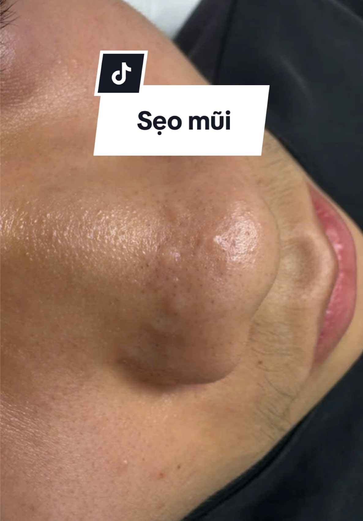 SẨn sẹo mũi là những nốt sẹo cục gôm lên trên bề mặt. Rất dễ nhầm lẫn với mụn mũi. Xử lý nhanh nhất và hiệu quả nhất cùng# Mia Clinic
