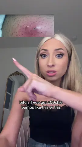 This video is for women only #ingrownhair 