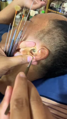 #asmr #earwaxremoval #ear #earwax #removal 