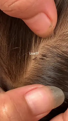 #removalice #tiktok_india #lice #omg🥶 