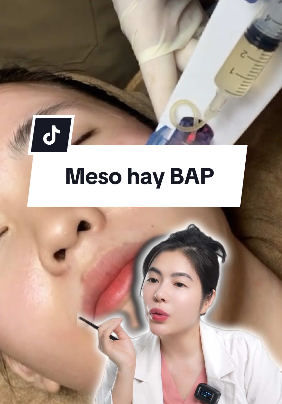 Meso không kim #bacsinhung #xuhuonglamdep #kienthucchamsocda 