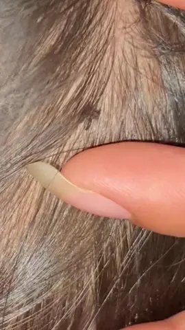 😱😱😱#omg #lice #liceremoval 