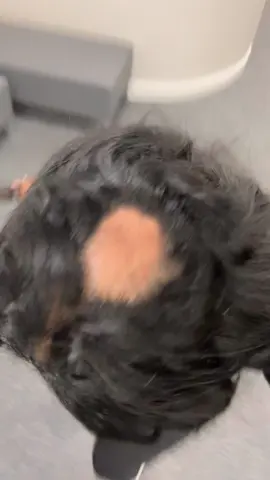 All jokes aside, ALOPECIA is a BITCH and I’m ready to FIGHT HER 😂 Alopecia Areata is an autoimmune condition that causes hairloss in patches. Outbreaks can happen due to increased stress, hormonal changes but honestly no one really knows what causes alopecia😂😂😂 I’m laughing to hide my pain, I cry every single day hoping my hair continues to grow and I don’t have another outbreak.#alopeciaawareness #alopecia #alopeciaareata #blackwomenwithalopecia #hairloss 