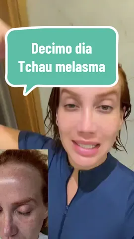 Décimo dia  🥹❤️👆🏻 #melasma #envyskin #tratamentomelasma 