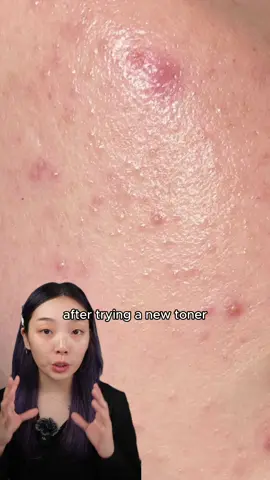 if u started getting fungal acne after trying a new toner make sure to check out the orien mugwort toner, one of the few fungal acne safe toners thats in a spray type so you dont need to touch your face to worsen your breakout and if you want to try it out you can get it on amazon! #orienpartner @ORIEN   #zerofilm #zerofilmchallenge #koreantoner #toners #toner #skincaretiktok #glassskin #kbeauty #skincaretips #skincareroutine #skincareempties #kbeautyfinds #kbeautyproducts #koreanskincaretips #koreanskincaretiktok #koreanbeauty #skincareforbeginners #glowyskin