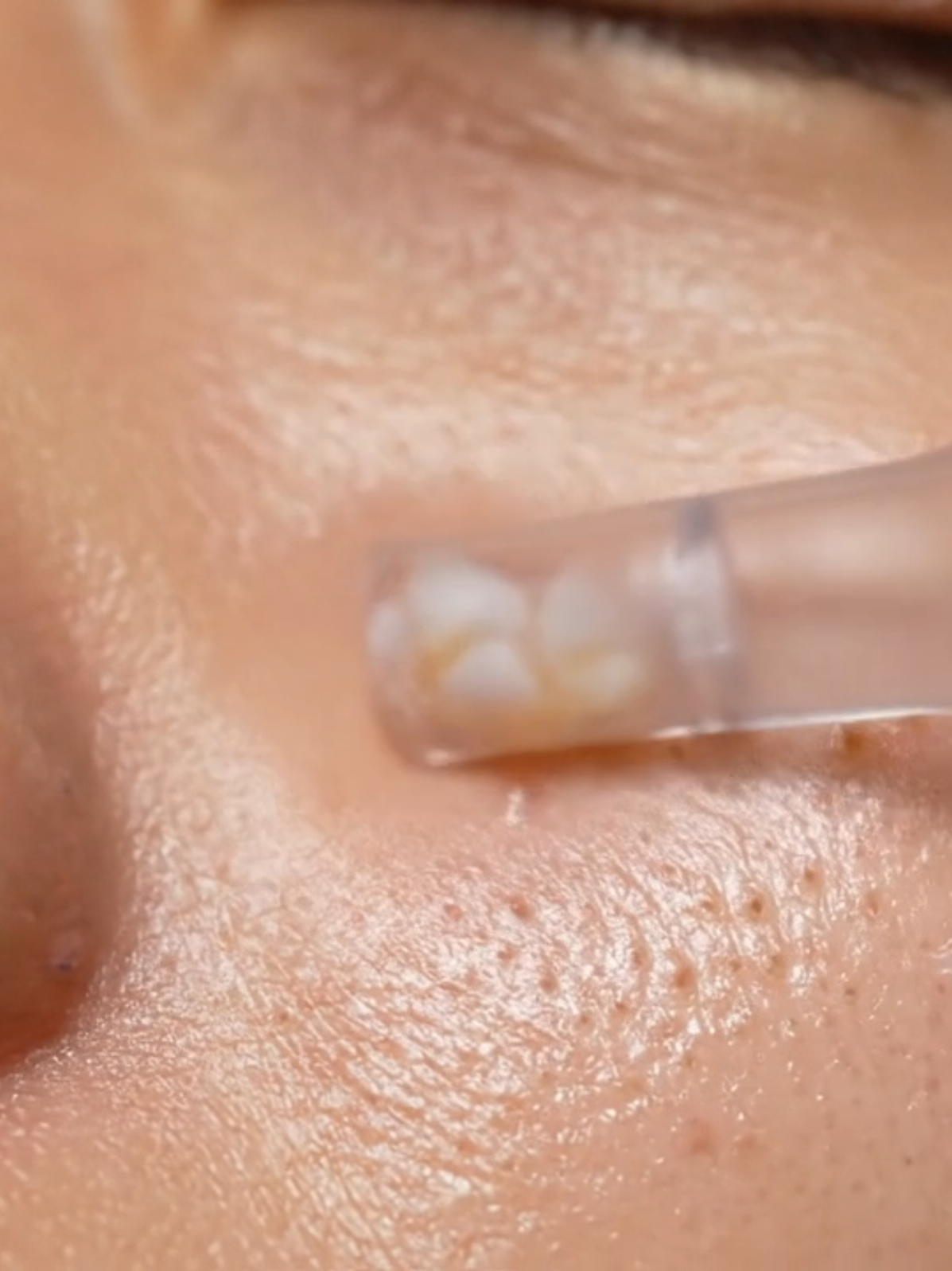 Watch those pores empty — like vacuuming your face 😮‍💨 #Veo3 #PoreVacuum #MacroClean #RealisticSkincare #VisualASMR #PoreExtraction #SatisfyingSuction #8KMacroBeauty #blackheadpull 