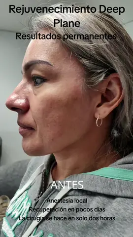 Rejuvenece tu rostro de forma permanente y segura 👱 Realizamos la técnica más sofisticada del mundo (cirugía de plano profundo 