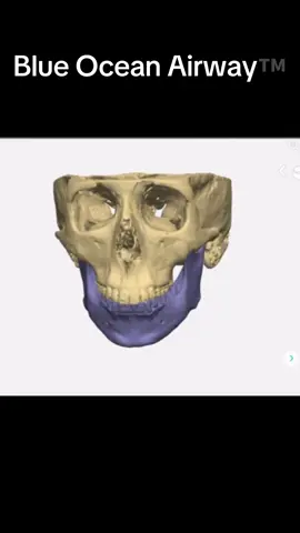 Custom Ortho Surg. Blue Ocean Airway™️ jaw alignment 