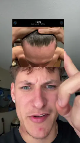 This is the only thing to work for me #hairline #men #bebodywise 