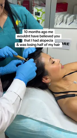 I didn’t even want to go outside for those months 🥹 #alopecia #hairloss 
