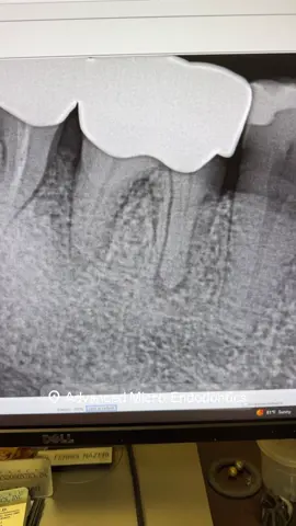 Do I need a cbct? #dentists #endodontist #rootcanal #dentistry #dentalassistant #dentalhygienist #dentalstudent 