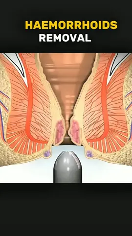 Haemorrhoids removal (3d animations) Disclaimer: This video is for educational purposes only and is intended to raise awareness about medical procedures. It does not violate  TikTok community guidelines and contains no graphic or harmful content. #haemorroidawareness #removal #medicaleducation #healthawareness #healtheducation 