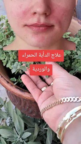 #علاج #علاج_طبيعي #علاج_بالاعشاب #الوردية#الدأبة_الحمراء #الوردية #حساسية_البشرة #وصفات #وصفات_طبيعية 