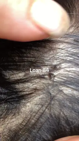 clean lice #lice #😱😱😱 #omg😱😱 #trending 