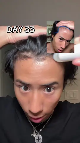 DAY 33 of using bodywise hair growth serum #balding #hairthinning #hairgrowth #bodywise #hairline 