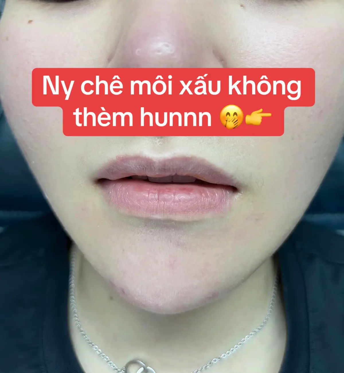 B.S sale off 70% hết tháng 😚 #fillermoi #filler #botox #fillerfullface #làmđẹp #fyp 