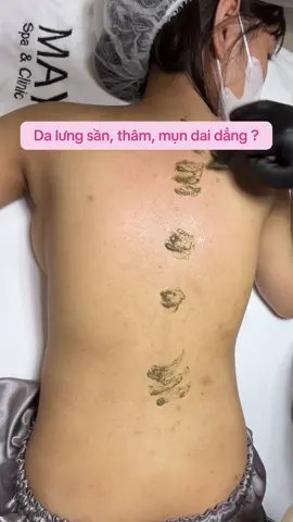 Thâm mụn lưng dai dẳng không còn là nỗi lo #mayspa #peel_lưng_thâm_mụn #trị_mụn_chuẩn_y_khoa #spa_thanh_xuân_HN #dượcmỹphẩm 