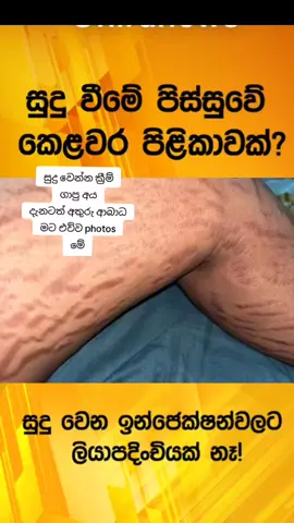 සම සුදු කරන ආලේප්න #fypシ #onemillionaudition #foryoupage #foryou #fypシ゚viral #fyp #strechmark 