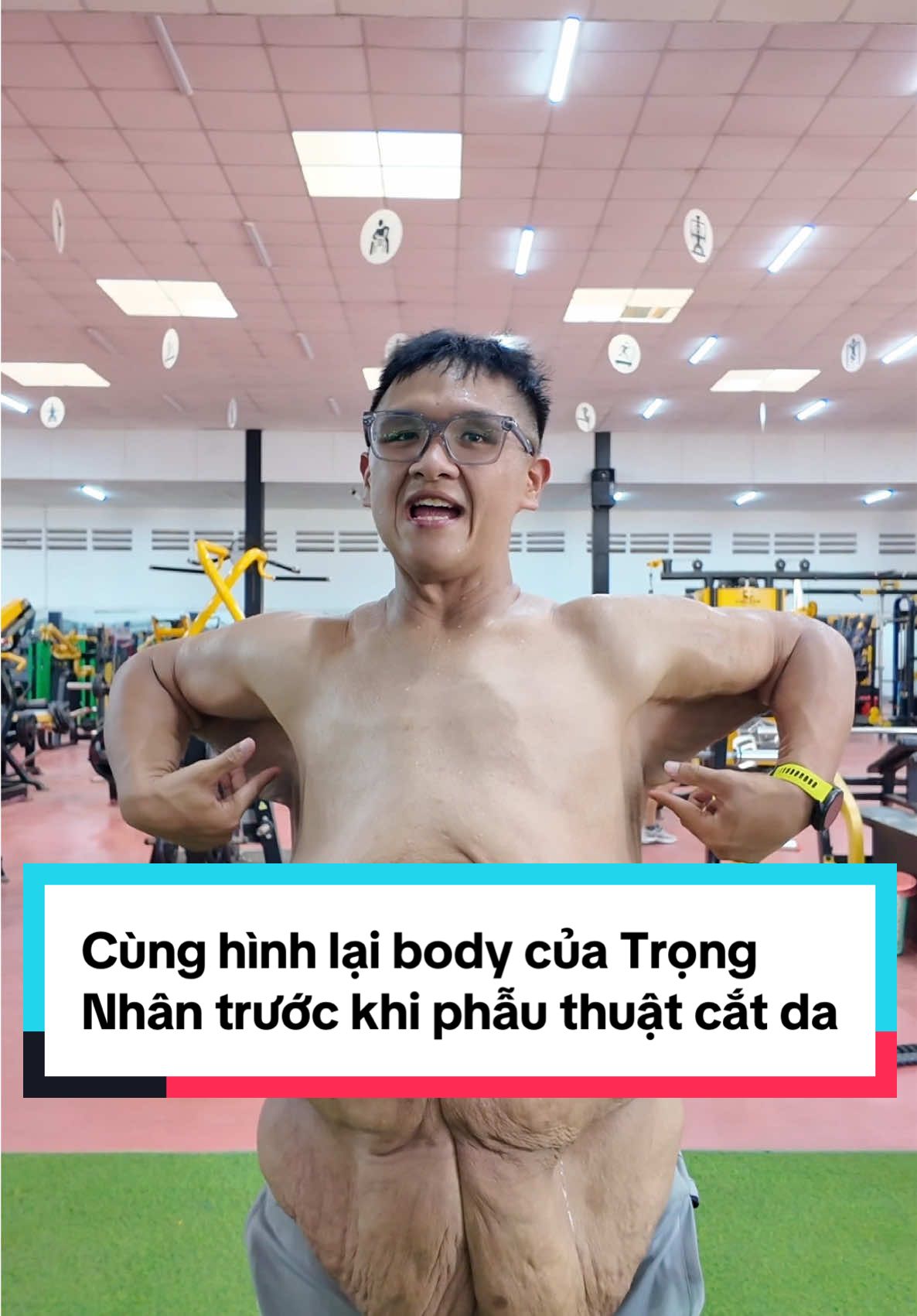 Cùng hình lại body của Trọng Nhân trước khi phẫu thuật cắt da. #nhantapkhoinghiep #trongnhanbyebeo #trongnhantaisinh 