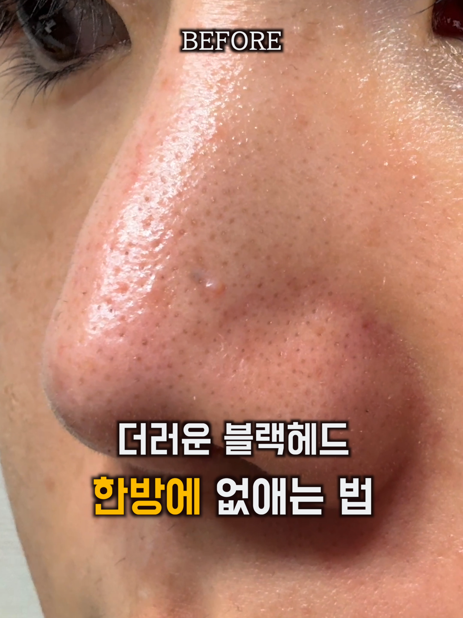 집에서 블랙헤드 10분 만에 싹. 다. 없애는 법 #블랙헤드 #블랙헤드제거 #블랙헤드관리#블랙헤드없애는법 #피지관리#피지제거 #모공관리#모공케어 #피부관리 #피부좋아지는법 #뷰티틱톡