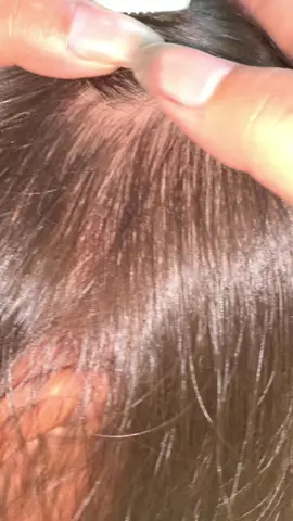 😱😱😱😱😱😱#omg #lice #liceremoval 