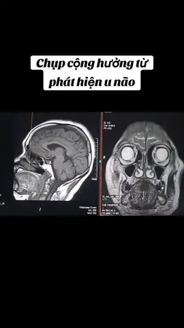 Đau đầu, chóng mặt, chụp mri phát hiện u. Sau 1 năm chụp lại và kết quả...😢 #ct #mri 