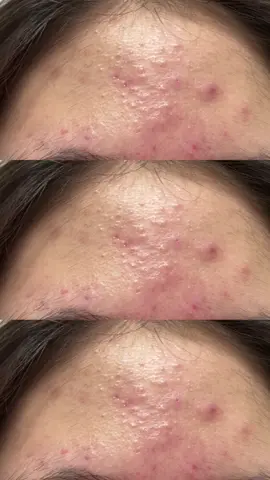 이런 여드름은 어떻게 하나요ㅠㅠ 사춘기 여드름같은데 몇년째 좋아졌다 안좋아졌다 반복중이에요.. 피부과 약도 소용이 없는데 어떻게 해야하나요ㅠㅠ 이마가 제일 심해요 #여드름 #사춘기여드름 #이마여드름 #심한여드름 #여드름좋아지는법 #피부좋아지는법