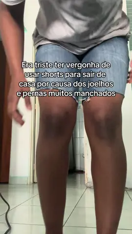 Noussa, era tris te viu, só quem passa ou já passou por isso vai me entender #clareadordemanchas #fyp #vaiprofy 