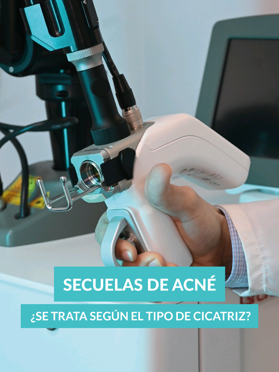 ¿Tu piel aún guarda las huellas del acné? 🧬 No todas las cicatrices son iguales… ¡y tampoco deberían tratarse igual! Picahielo, rolling, boxcar o hiperpigmentaciones: cada una necesita un enfoque distinto. ✨ En Esthetic Fit combinamos tecnología real + evaluación médica personalizada para diseñar el tratamiento ideal para ti. 📍 Tu piel merece un plan único. 📌 Atención previa cita 📱 959 319 700 📍 Visítanos en Av. Belaunde Oeste #888 Piso 2 - Comas / Ref: Cruce con Av. Universitaria . . . #secuelas #secuelasdeacne #cicatrices #tratamientolaser #peeling #bioestimuladores #YouLaserMT  #EstheticFit 