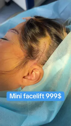 #surgery #operation #lamdep #thammy #facelift #cangdamat #fullfacelift #minifacelift 