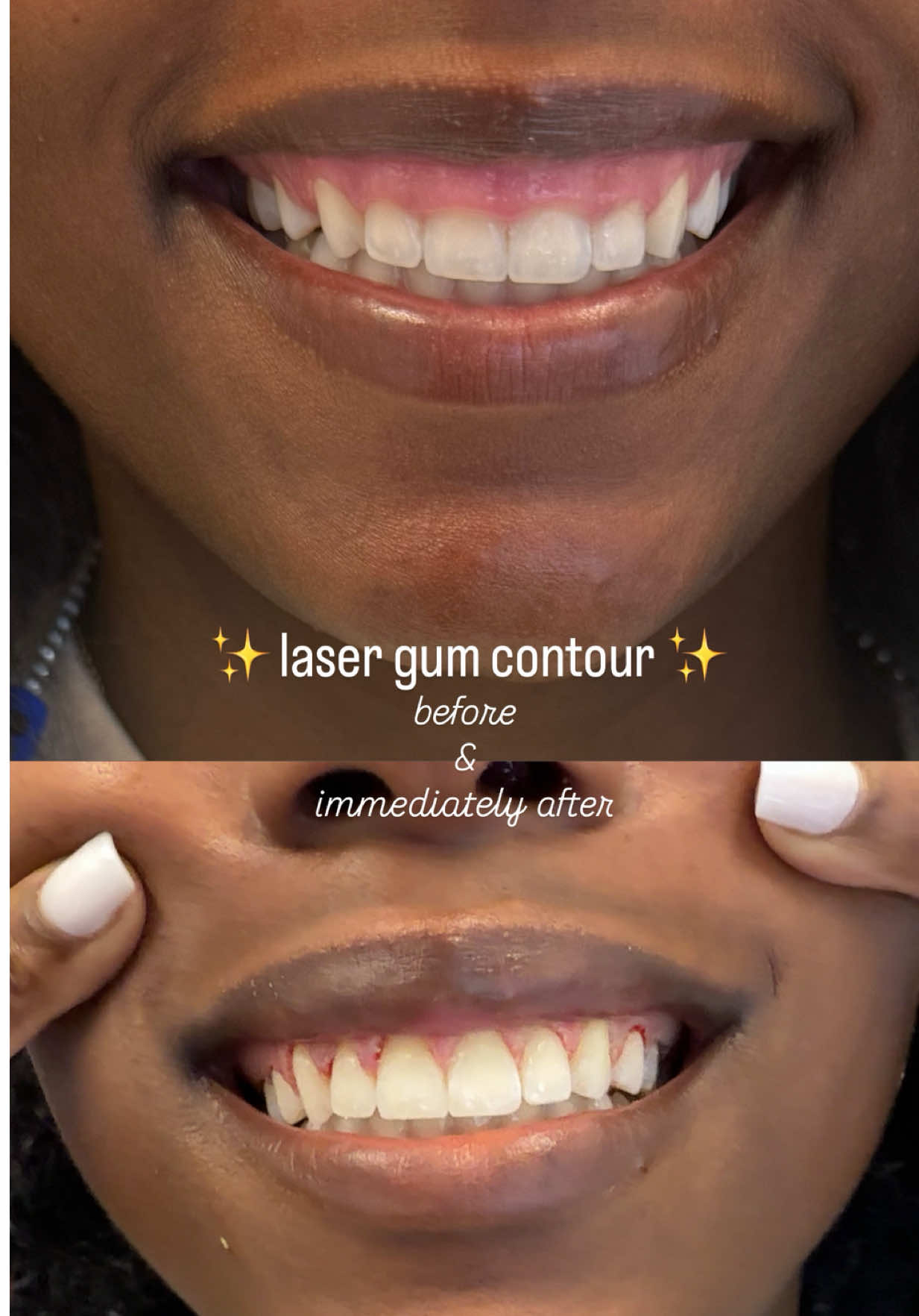 no her teeth weren’t small they were just shy 🙈. we switched up her naturally gummy smile and still kept things 100% natural. ~20 mins chair time, painless, no stitches, easy healing. pics are before and immediately after (hence why the little bit of 🩸). FYI this is an elective cosmetic procedure. Price will increase to $2000 for the full procedure on Sep 1! Book now to lock in the price now at $1750 for 10 teeth 🥰 