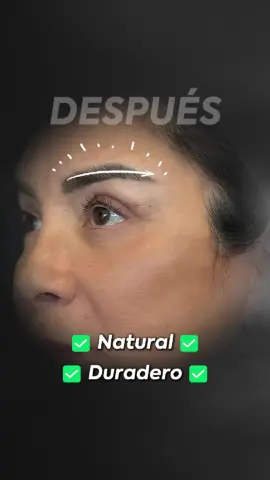 ✨ Una mirada fresca cambia todo. Con la técnica Deep Plane logramos: ✅ Elevar y rejuvenecer la mirada ✅ Redefinir la posición natural de las cejas ✅ Resultados duraderos y sin cicatrices visibles En Elebelle, la belleza se nota… sin que sepan por qué. ✨ #Tacna #peru #bellezanatural #rejuvenecimientofacial #levantamientodecejas #elebelle #chile 