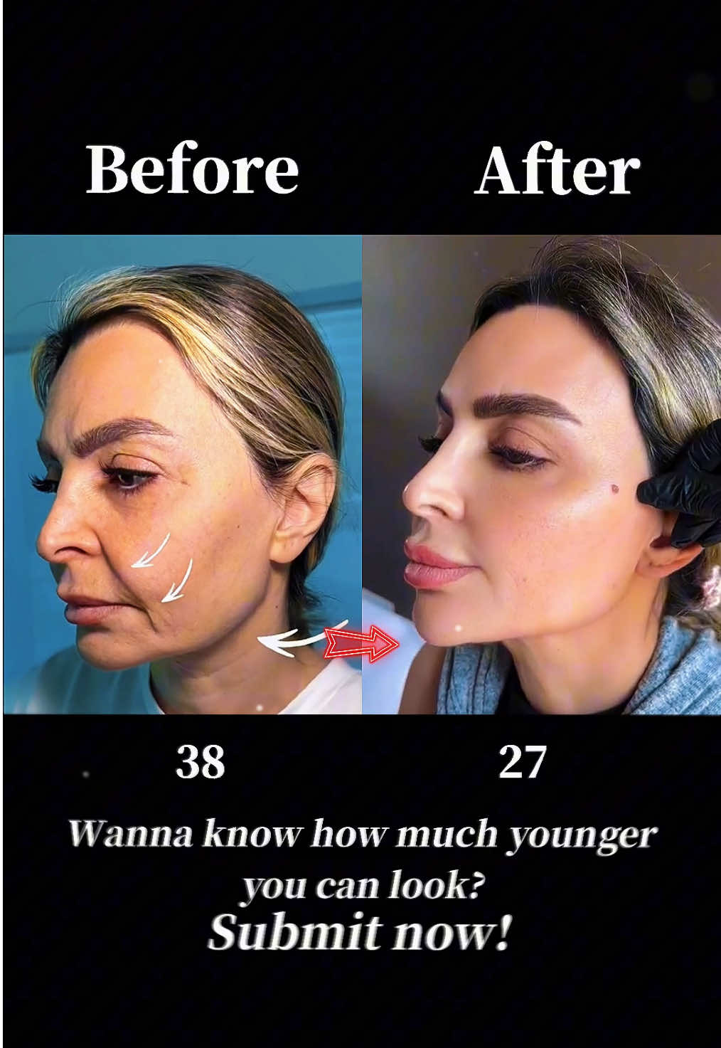 #facelift #antiaging #facelifting #plasticsurgery ‎#تركيز الوجه#拉皮手术 