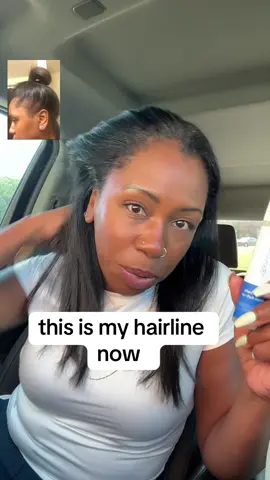 @Bodywise is the easiest to use and most effective hair growth serum i’ve used #hairgrowthtips #regrowth #hairgrowthserum #regrowth #bodywisehairgrowthserum #hairgrowthjourney #hair 