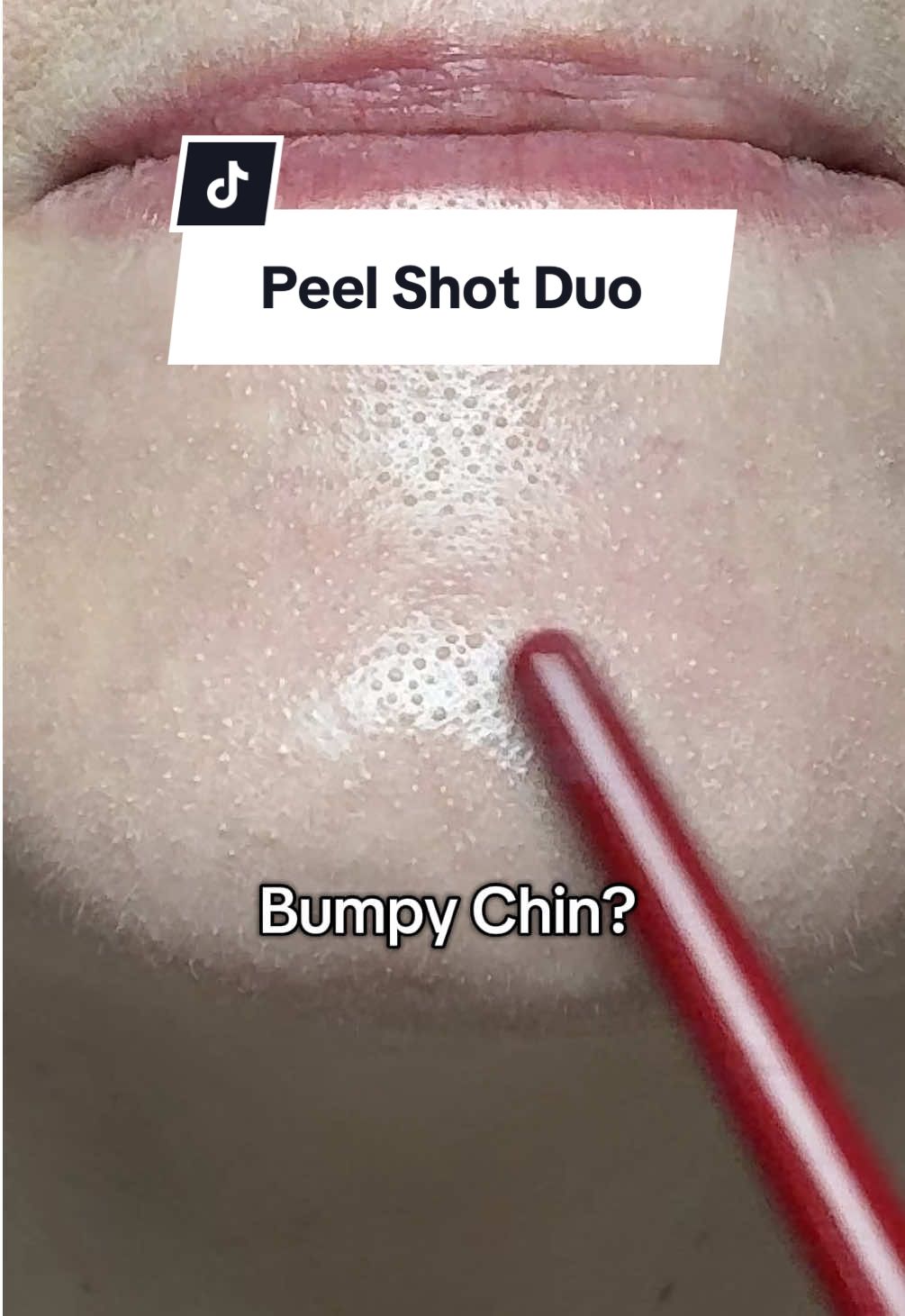 Blackheads, clogged pores, bumpy chin, dull dry skin? Dr Melaxin Peel shot duo helps to address skin issues to reveal revitalized radiant skin. 🙌🏻 #drmelaxin #peelshot #kbeauty #skincare  #skincare #exfoliation #glassglowskin #koreanskincare #glowyskin #skincaretips #beauty
