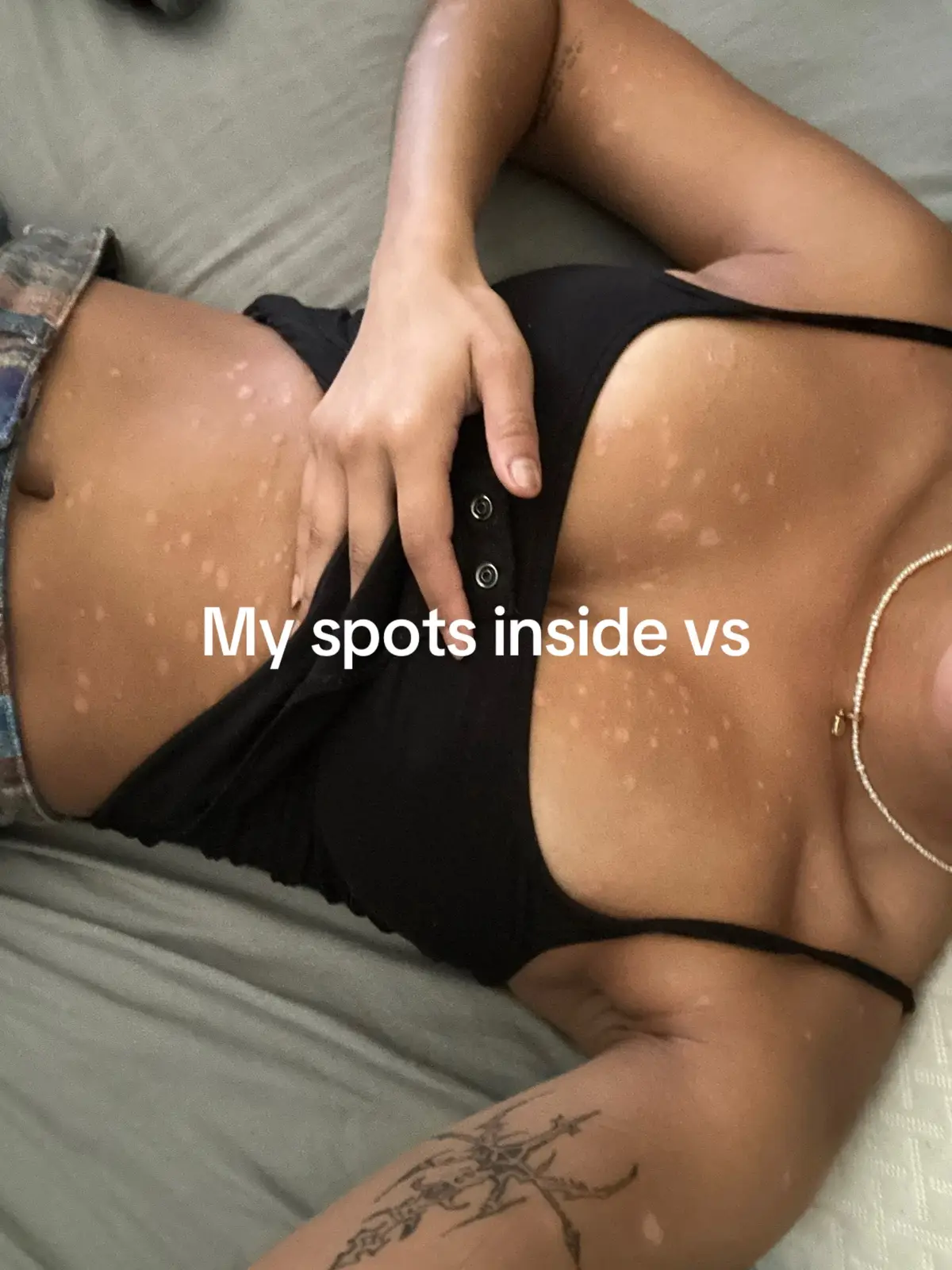 Don’t be scared it’s just psoriasis I promise 