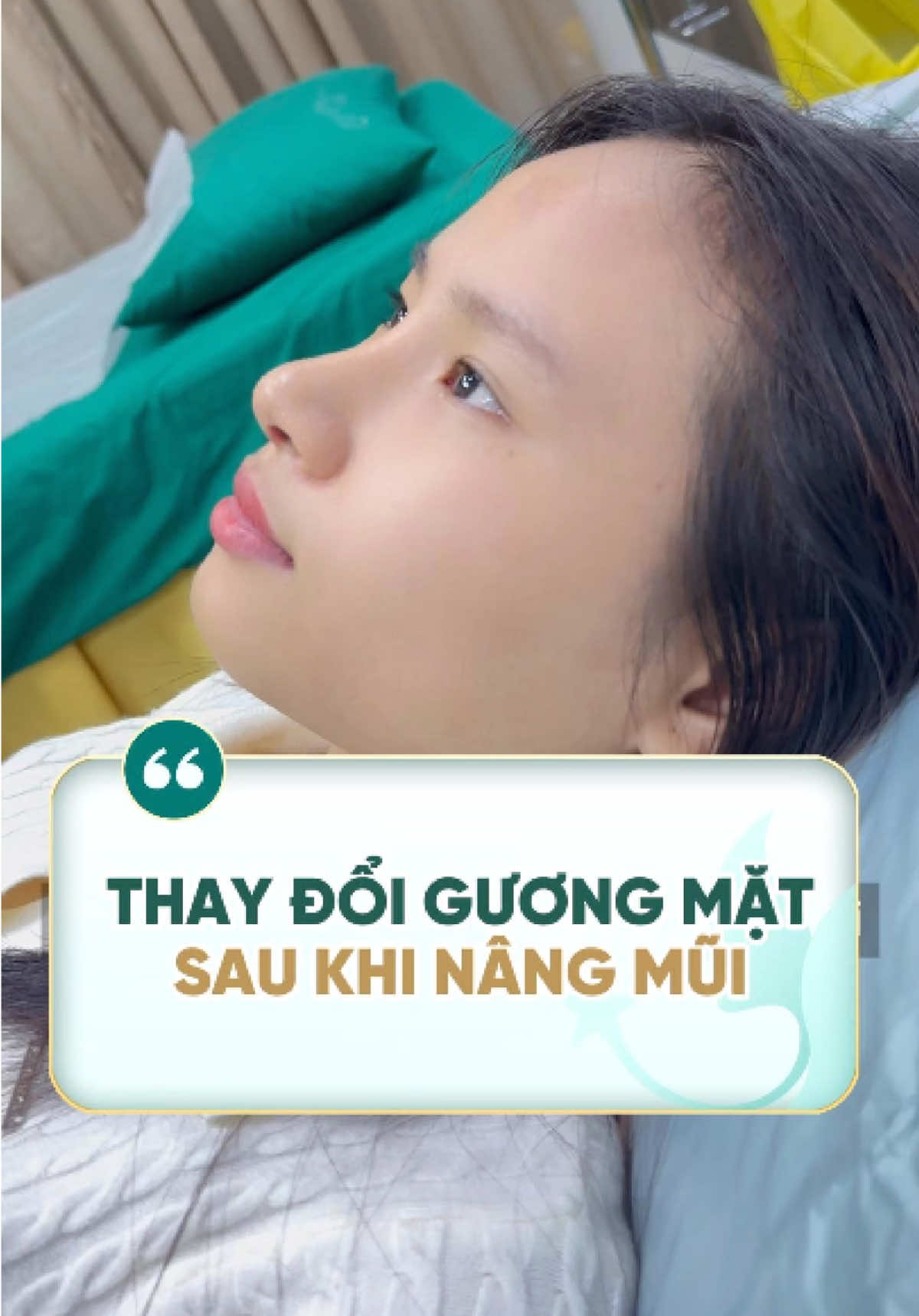 Thăng hạng nhăn sắc chỉ sau 10 ngày nâng mũi 😘😘😘 #drhoat #bacsihoat #nangmui #nangmuicautruc #suamuihong #nangmuisline #NangMui 