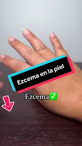 Ezcema en la piel #enviogratis #ezcema #dermatology #dermatitis #ezcemaenlapiel 