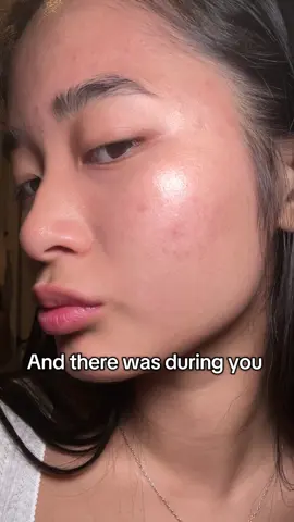 My acne #myacne #acnetips #acnebreakout #skinbreakout #skincare #summeracne #clearacne #livingwithacne #skincarewithacnescars #acneprone #fyp #korean #creatorsearchinsights 
