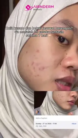 ga butuh waktu lama, asal konsisten pake salicylic acid + niacinamide!😘💖 #airnderm #airinbeauty 