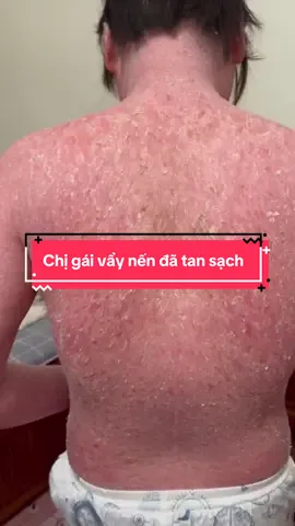 Chị gái vẩy nến tan trắng đẹp lấy lại được sự tự tin rồi các bác @Thị Tuyến DC 35(2) #vaynen  #viemdacodia 