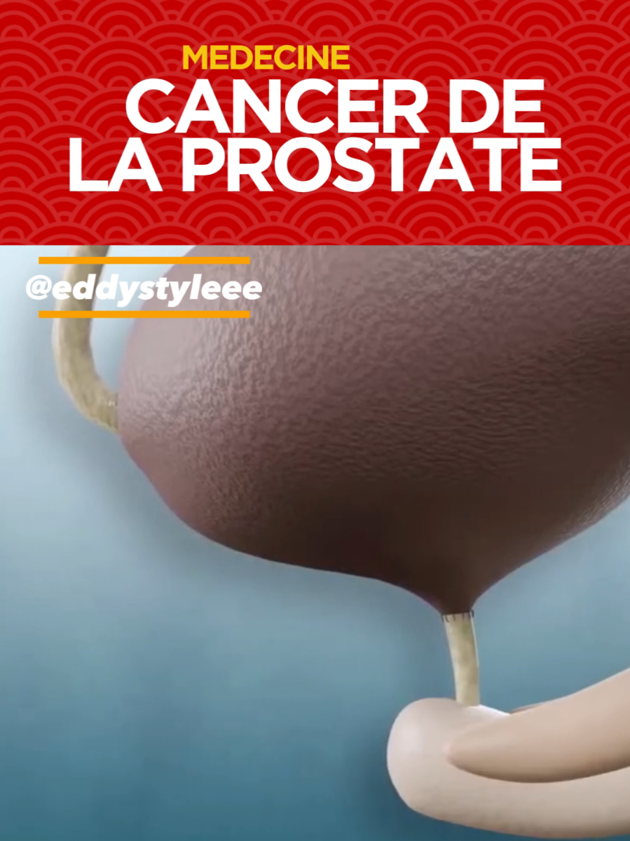 #cancer #prostat #prostatitis #chirurgie  