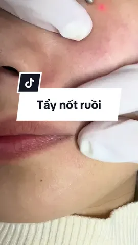 X.ử l.ý nốt ruồi an toàn nhất 