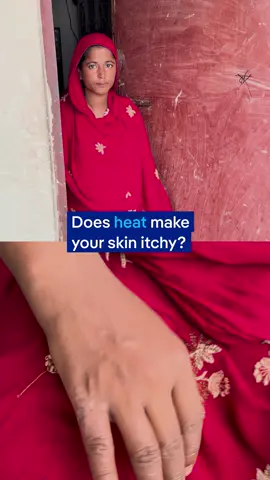 Itchy skin and rashes during extreme hot weather? In this video we explore why skin infections are common during heat waves, and what you can do about it without spending much. South Asia has been among the first regions to face the severe effects of climate change, with recurring extreme heat waves. Despite this, there is limited academic research on how heat impacts women’s health. The Ladies Survival Guide is a video series that brings questions from those affected by heat directly to a top environmental public health expert. Author: Sushmitha Ramakrishnan, Kate Martyr #DW_LSG #dwasia #dwscience #dwhealth #globalwarming #skincare