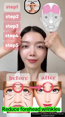 Say goodbye to forehead wrinkles .The Secret to a Smooth Forehead is Out ✨#ForeheadWrinkles #SkincareRoutine #FacialMassage #fyp #BeautyHacks 