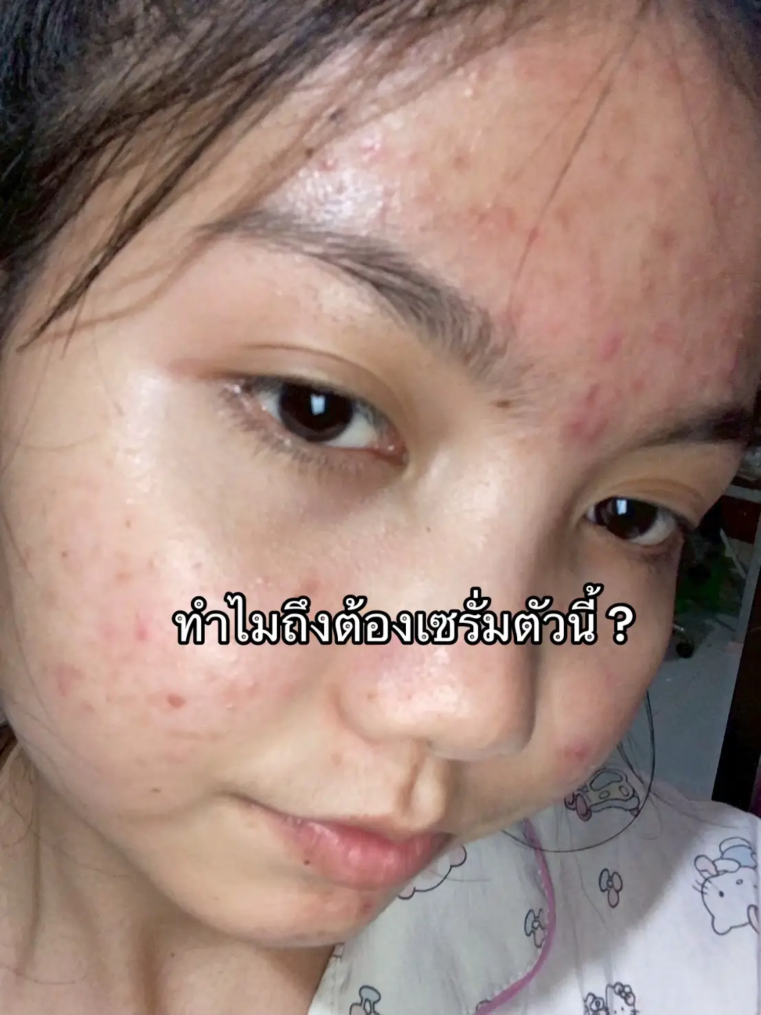 #เซรั่มกาญจนา #น้องมีนสมุนไพรกาญจนา #ใช้ดีบอกต่อ #สกินแคร์ #สิว #ดูแลตัวเอง #รีวิวของดีบอกต่อ #รีวิวบิวตี้ #เปิดการมองเห็น 